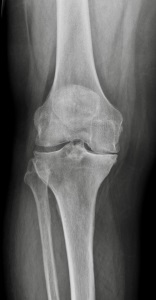 Abbildung 5 schwere Arthrose des Kniegelenks