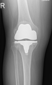 Abbildung 6 individuell angefertigte Knieprothese