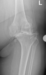 Abbildung 7 schwerste Arthrose des Kniegelenks mit Instabilität der Seitenbänder