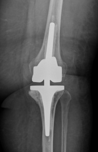 Abbildung 8 gekoppelte Knieprothese zum Ersatz der Seitenbänder