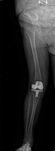 Abbildung 9 Fehlimplantation einer Knieprothese in X-Bein Stellung
