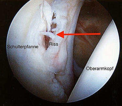 Bild zeigt arthroskopische Darstellung der abgerissenen Knorpellippe, vorne an der rechten Schulterpfanne ( sog. Bankart Läsion ), nach einer Schulterausrenkung.