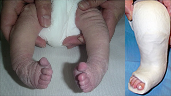 Bild links: Beidseitiger, angeborener Klumpfuß. Bild rechts: Gipsredression rechter Fuß in der Technik nach Ponseti