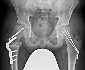  Imhäuser-Osteotomie rechts und Drähte beidseitig