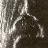 Ultraschallbild eines Säuglingshüftgelenk Typ II 