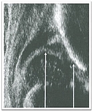 Ultraschallbild eines Säuglingshüftgelenk Typ III 