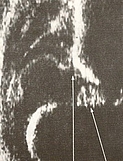 Ultraschallbild eines Säuglingshüftgelenk Typ IV
