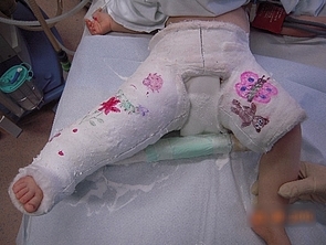 Bild zeigt Becken-Bein-Gips