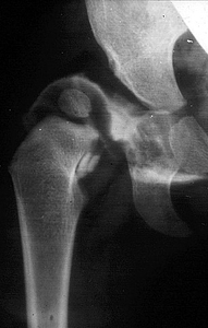 Arthrographie des Hüftgelenkes: Kontrastmittel umspült den luxierten Hüftkopf