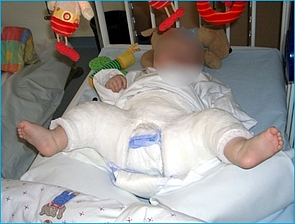 Bild zeigt Fettweishockgips