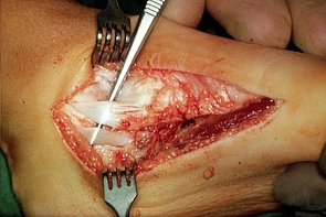 Bild zeigt Sehne des M. tibialis posterior