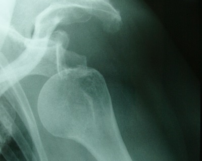 Röntgenbild der linken Schulter: Der Oberarmkopf ist aus der Schulterpfanne ausgekugelt