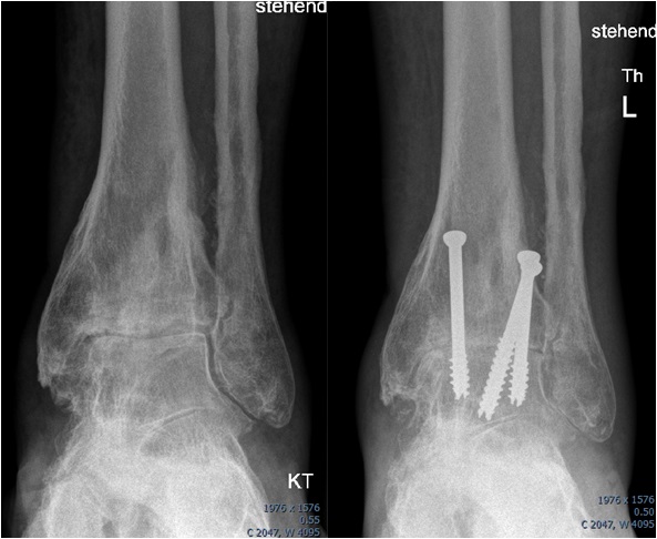 Bild Links: Fortgeschrittene Arthrose des oberen Sprunggelenks (OSG) mit deutlicher Gelenkspaltverschmälerung. Bild Rechts: Sprunggelenksversteifung (OSG-Arthrodese) durch eine Schraubenosteosynthese.