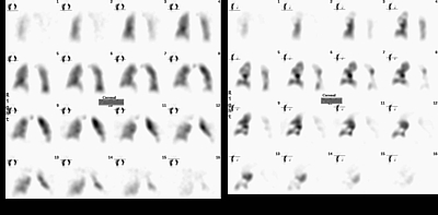Bild zeigt Ventilations- (linke Serie) und Perfusionsszintigraphie mit Nachweis mehrerer Perfusionsausfälle im Sinne von Lungenarterienembolien.