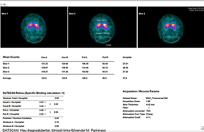 Bild zeigt DATSCAN ®: Patient mit M. Parkinson (klinisch links-führend)