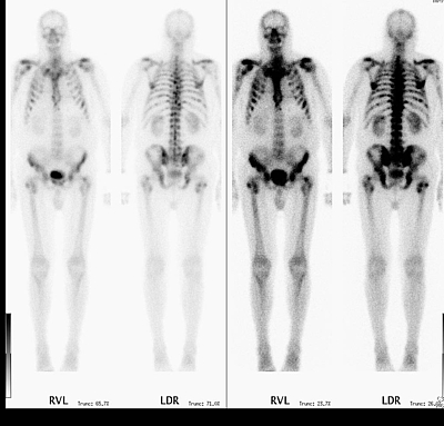 Bild zeigt Skelettszintigraphie: Ossär metastasiertes Prostatakarzinom