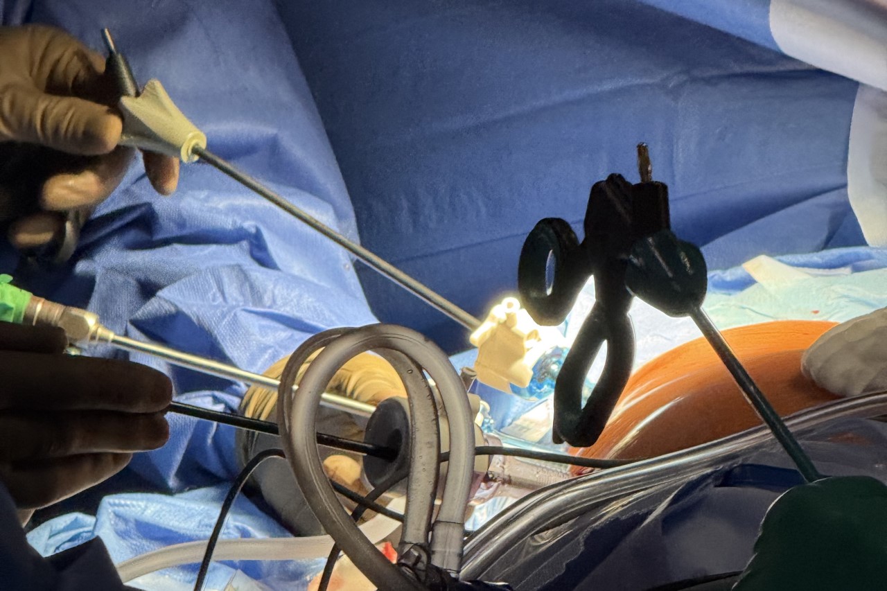 Minimalinvasive Operation