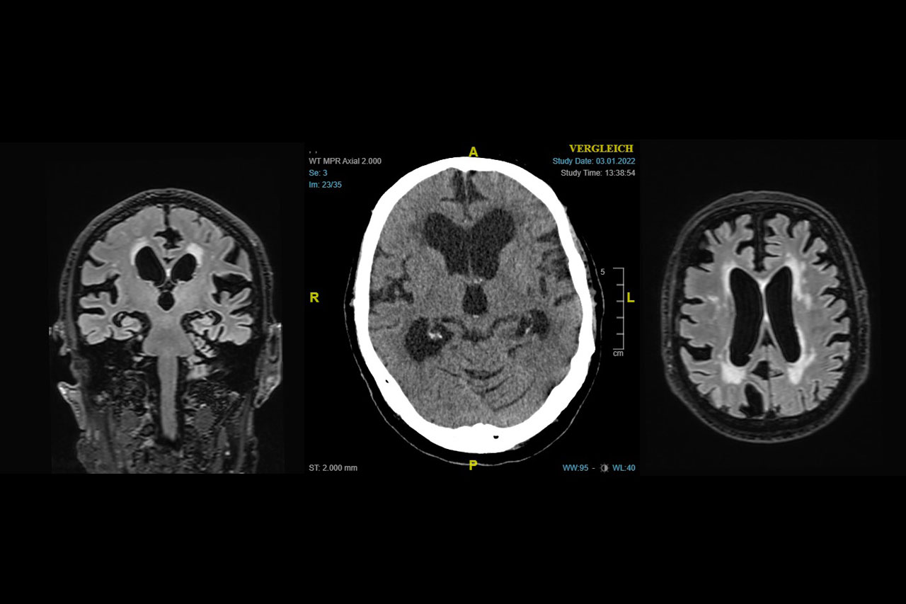 Normaldruck-Hydrocephalus