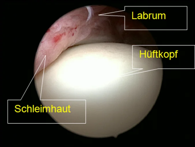 Arthroskopischer Blick in ein Hüftgelenk