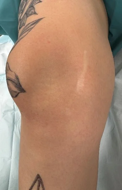 Rechtes Knie, nach außen luxierte Kniescheibe