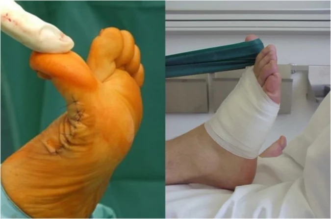 Hallux rigidus mit deutliche Verbesserung der Beweglichkeit des Großzehengrundgelenks unmittelbar nach der Operation. Beübung der Dorsalextension mit dem Theraband am 1. postoperativen Tag unter physiotherapeutischer Anleitung.
