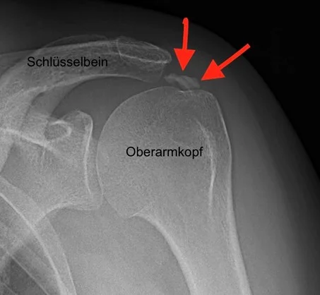 Große Sehnenverkalkung an der Schulter (Pfeile)