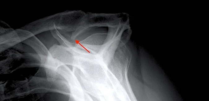 Großer Acromionsporn (Pfeil), der ein Impingement verursacht