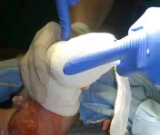 70° Abduktion des Fußes im Gips