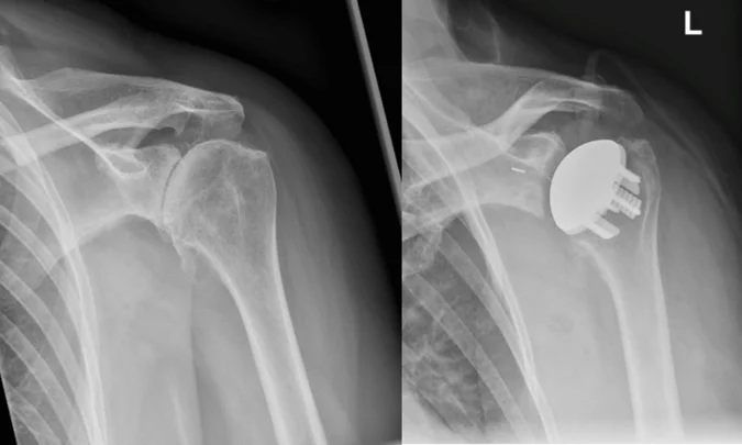 Röntgen Schultergelenksarthrose und anatomische Oberflächenprothese