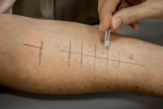 Epikutantest