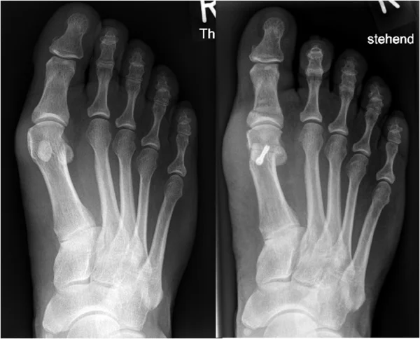 Links: Hallux valgus Deformität. Rechts: Operative Achskorrektur der Großzehe durch eine Chevron- und Akin-Osteotomie.