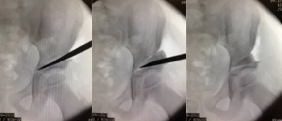 Azetabuloplastikoperation