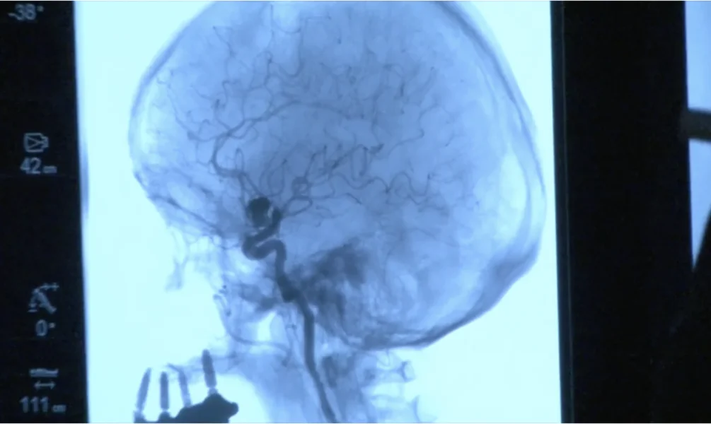  Hirn-Aneurysma-Therapie im Klinikum Dortmund