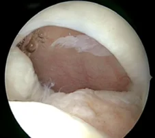 Riss der Supraspinatussehne im arthroskopischen Bild