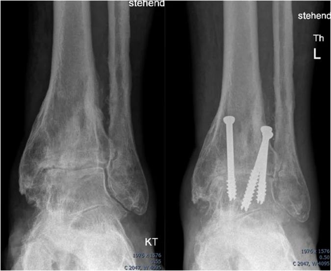 Links: Fortgeschrittene Arthrose des oberen Sprunggelenks (OSG) mit deutlicher Gelenkspaltverschmälerung. Rechts: Sprunggelenksversteifung (OSG-Arthrodese) durch eine Schraubenosteosynthese.
