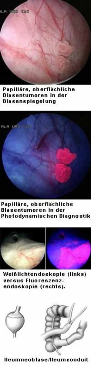 Behandlung Harnblasenkarzinom