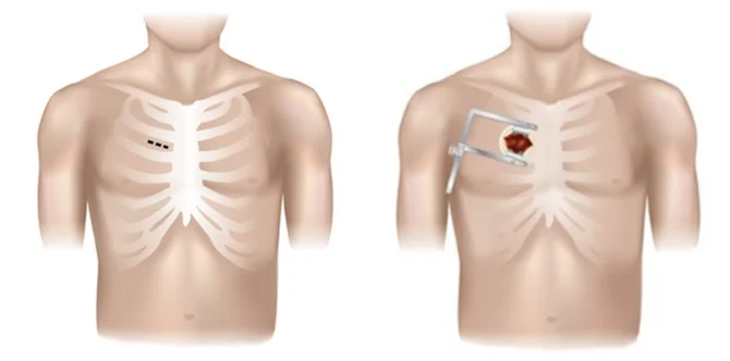 Die anterolaterale Mini-Thorakotomie